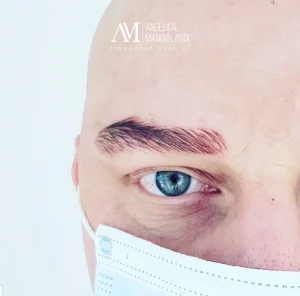 Alopecia Trattamento